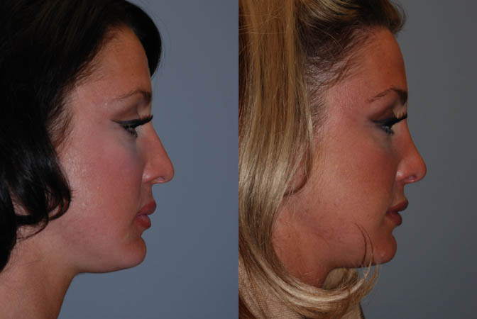 Nose contouring: Before and after rhinoplasty visual comparison