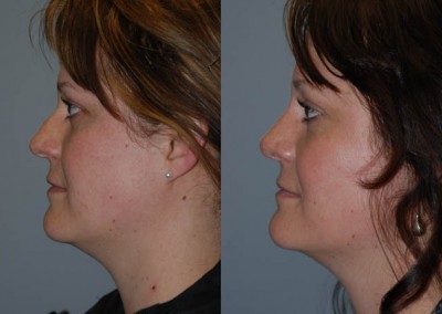 Facial profile improvement: Rhinoplasty before and after comparison
