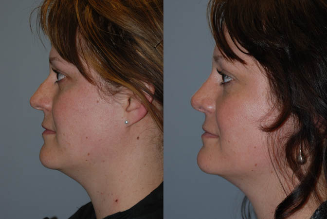 Facial profile improvement: Rhinoplasty before and after comparison