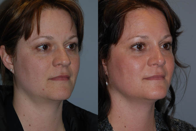 Nose job outcome: Before and after rhinoplasty progress
