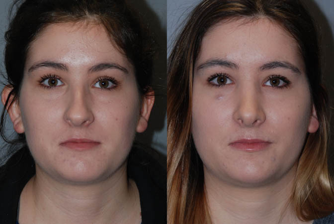 Nasal reconstruction: Rhinoplasty before and after snapshots
