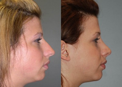 Facial feature refinement: Before and after rhinoplasty images