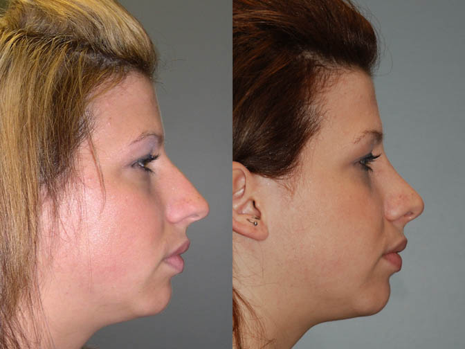 Facial feature refinement: Before and after rhinoplasty images