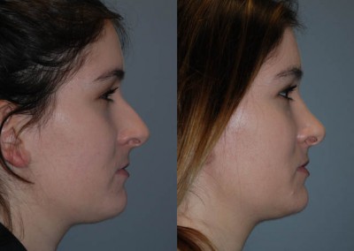 Rhinoplasty success: Transformative nose job results