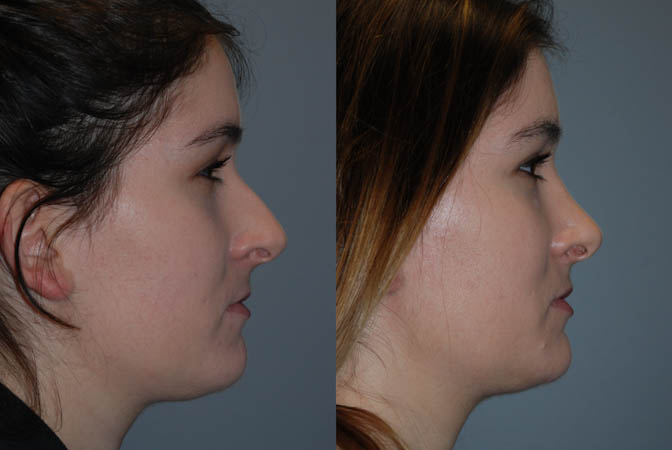 Rhinoplasty success: Transformative nose job results