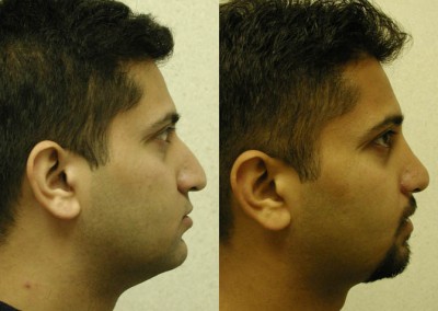 Nose size reduction: Rhinoplasty outcome visual comparison