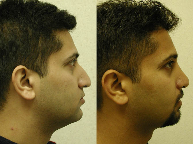 Nose size reduction: Rhinoplasty outcome visual comparison