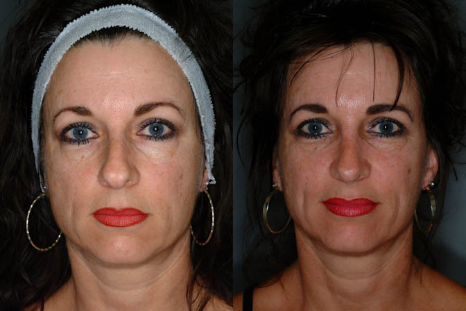 Nasal appearance transformation: Before and after rhinoplasty results