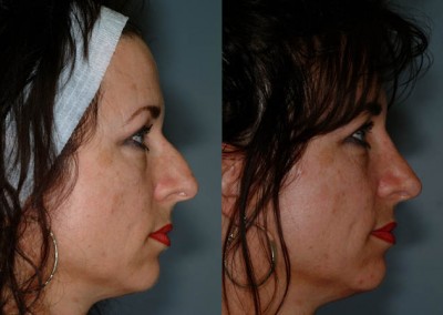 Facial aesthetics improvement: Rhinoplasty outcome comparison