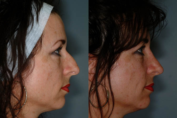 Facial aesthetics improvement: Rhinoplasty outcome comparison