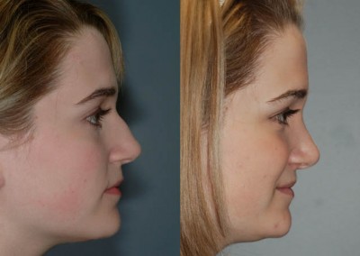 Nose appearance enhancement: Rhinoplasty before and after photos