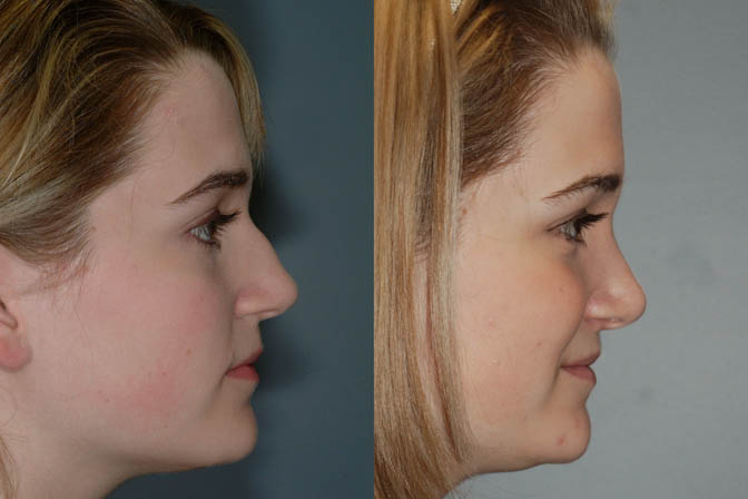Nose appearance enhancement: Rhinoplasty before and after photos