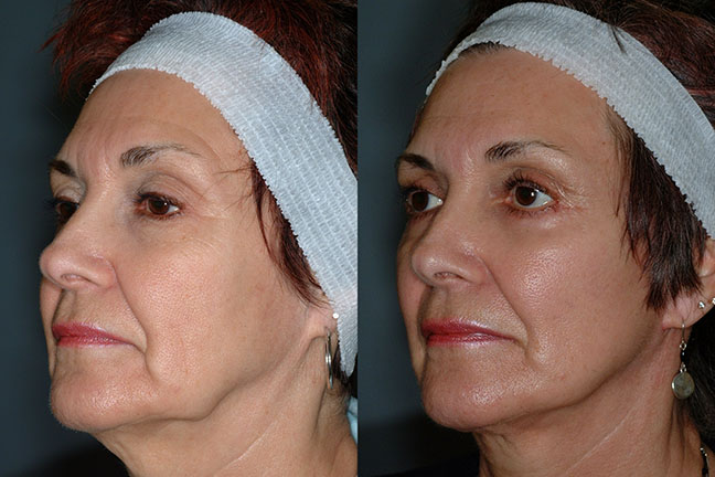 Facial transformation: Before and after images illustrating the dramatic change after Rhytidectomy