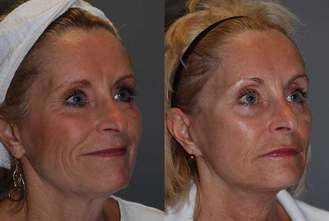 Youthful radiance: Before and after photos revealing the rejuvenating effects of Rhytidectomy
