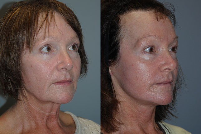 Rhytidectomy journey: Transformational images documenting the face and neck lift procedure