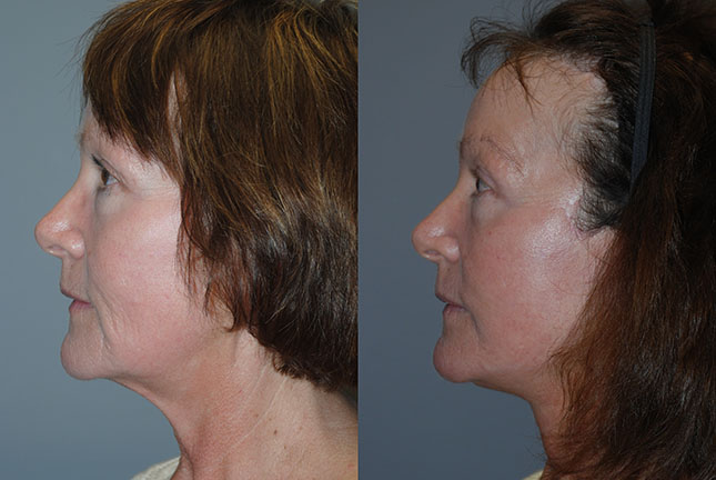 Improved facial definition: Comparison of facial appearance pre and post Rhytidectomy