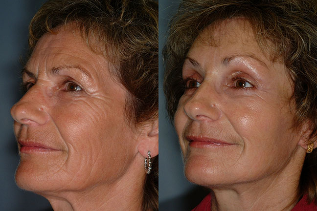 Restored youthfulness: Before and after photos depicting the rejuvenating effects of Rhytidectomy