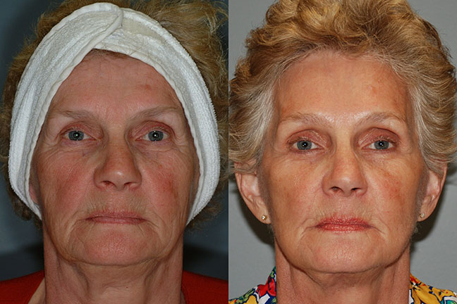 Facial lift journey: Before and after snapshots revealing the journey to facial rejuvenation