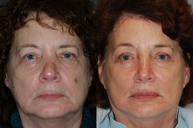 Facial rejuvenation journey: Visual documentation of the journey to facial rejuvenation