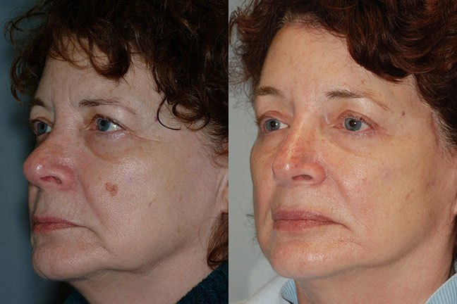 Facial contour enhancement: Comparison of facial contours before and after Rhytidectomy
