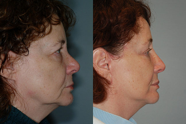 Facial lift transformation: Illustration of the transformative effects of Rhytidectomy