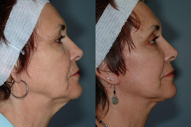 Restored youthfulness: Before and after snapshots capturing the revitalized appearance post-surgery