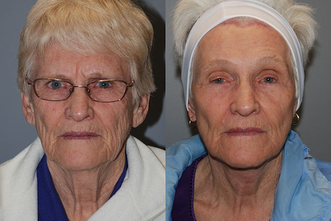 Facial lift success: Visual evidence of the successful outcomes of Rhytidectomy surgery