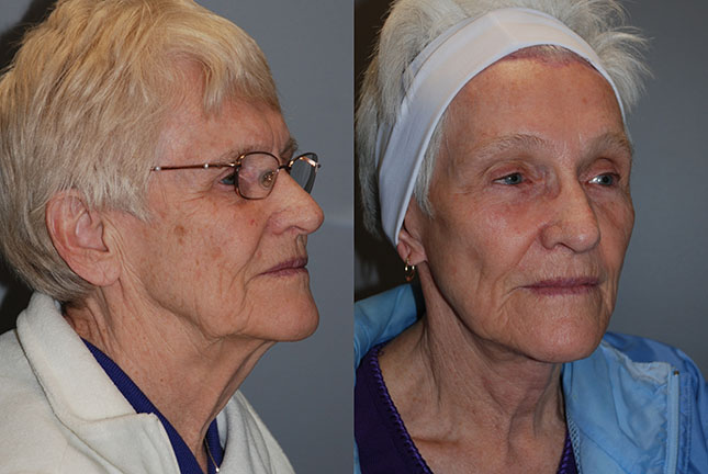 Enhanced facial structure: Comparison of facial structure before and after Rhytidectomy surgery