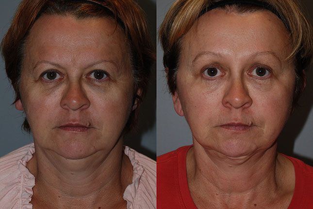 Enhanced facial appearance: Comparison of facial appearance before and after Rhytidectomy surgery