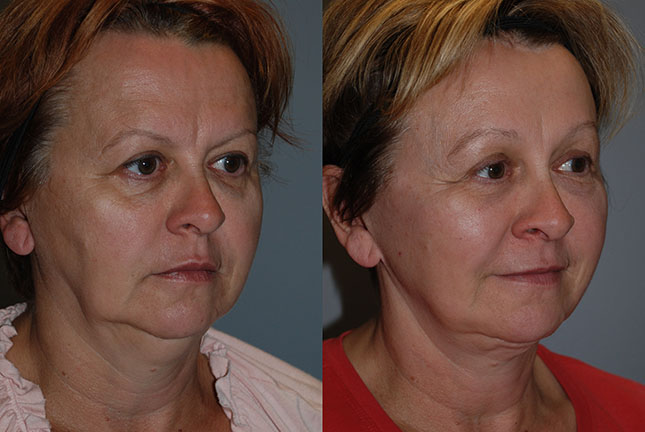 Facial rejuvenation results: Images illustrating the transformative effects of Rhytidectomy