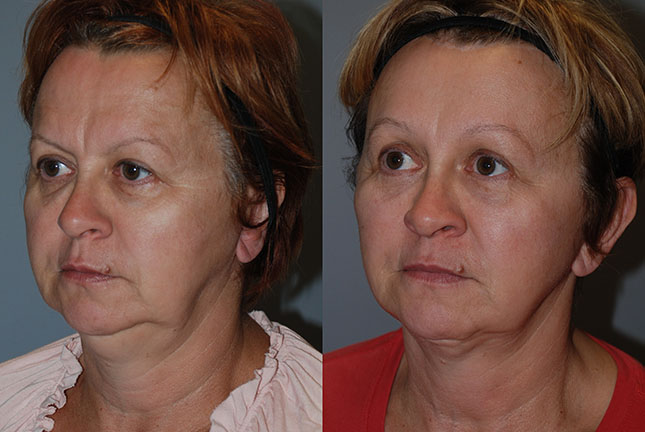 Facial lift success: Before and after snapshots showcasing the successful outcomes of Rhytidectomy