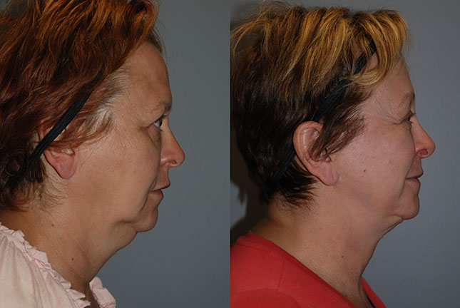 Facial lift journey: A visual representation of the journey to facial rejuvenation with Rhytidectomy