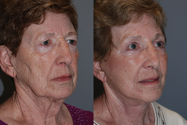 Improved facial symmetry: Visual comparison of facial symmetry pre and post Rhytidectomy