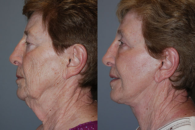 Facial refinement: Comparison of facial features before and after Rhytidectomy procedure