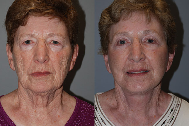 Facial lift success: Before and after photos showcasing the positive outcomes of Rhytidectomy