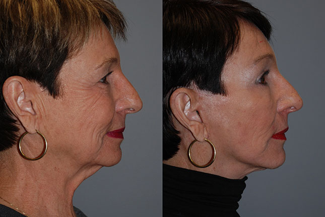 Enhanced facial structure: Before and after images showing the impact of Rhytidectomy