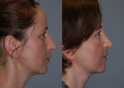 Nasal reshaping: Before and after septorhinoplasty progress snapshots