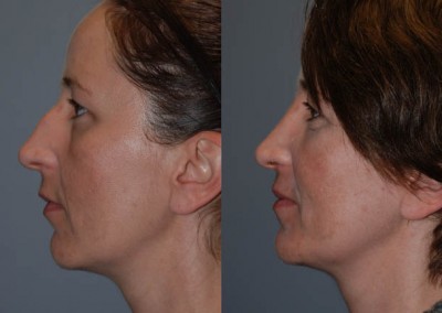 Facial harmony restoration: Transformative septorhinoplasty outcome