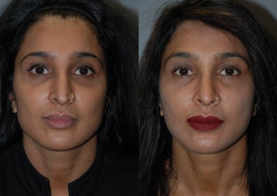 Rhinoplasty success: Before and after septorhinoplasty comparison