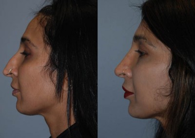 Septorhinoplasty results: Enhanced nose and facial aesthetics