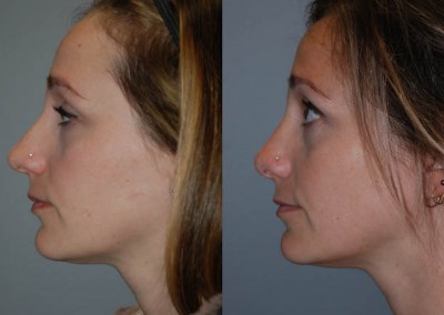 Nasal refinement: Before and after septorhinoplasty comparison