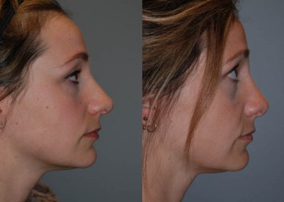Septorhinoplasty outcome: Improved nasal structure and facial balance