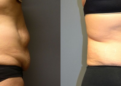 Waist Slimming Journey: Sequential photos portraying the progression of liposuction results on the abdomen and waist