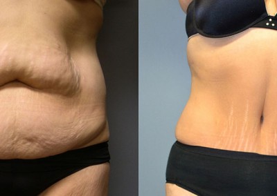 Abdominal Definition: Aesthetic evolution from pre-treatment to post-liposuction for abdomen and waist refinement