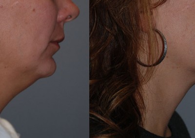 Neck rejuvenation results: Side-by-side view of chin and neck before and after liposuction procedure