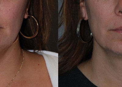 Neck contour refinement: Visual comparison of chin and neck pre and post liposuction