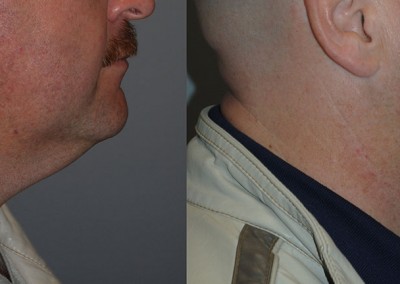 Enhanced neck profile: Before and after images of chin and neck following liposuction treatment