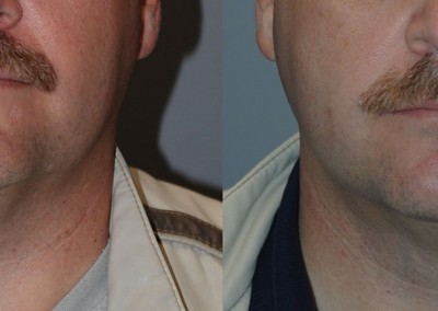 Neck liposuction outcomes: Comparison of chin and neck before and after the procedure