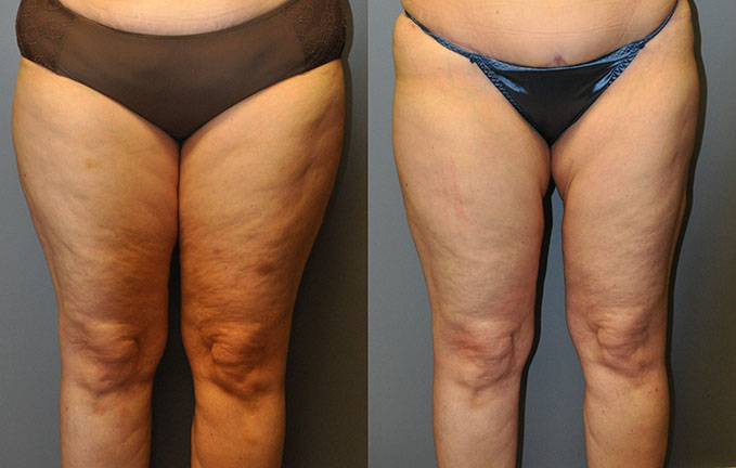 SmartLipo Lateral Thighs, Medial Thighs