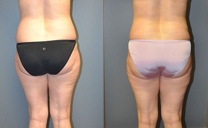 SmartLipo Medial Thighs and Abdomen